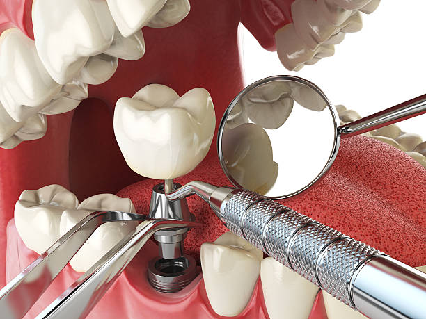 Best Emergency Treatment for Dental Infections or Abscesses in Mathews, VA